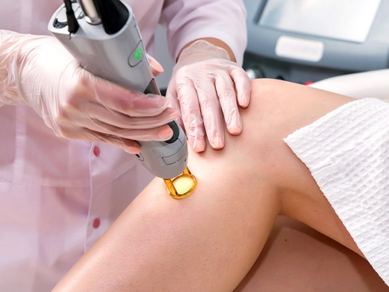 What is Laser Hair Removal?